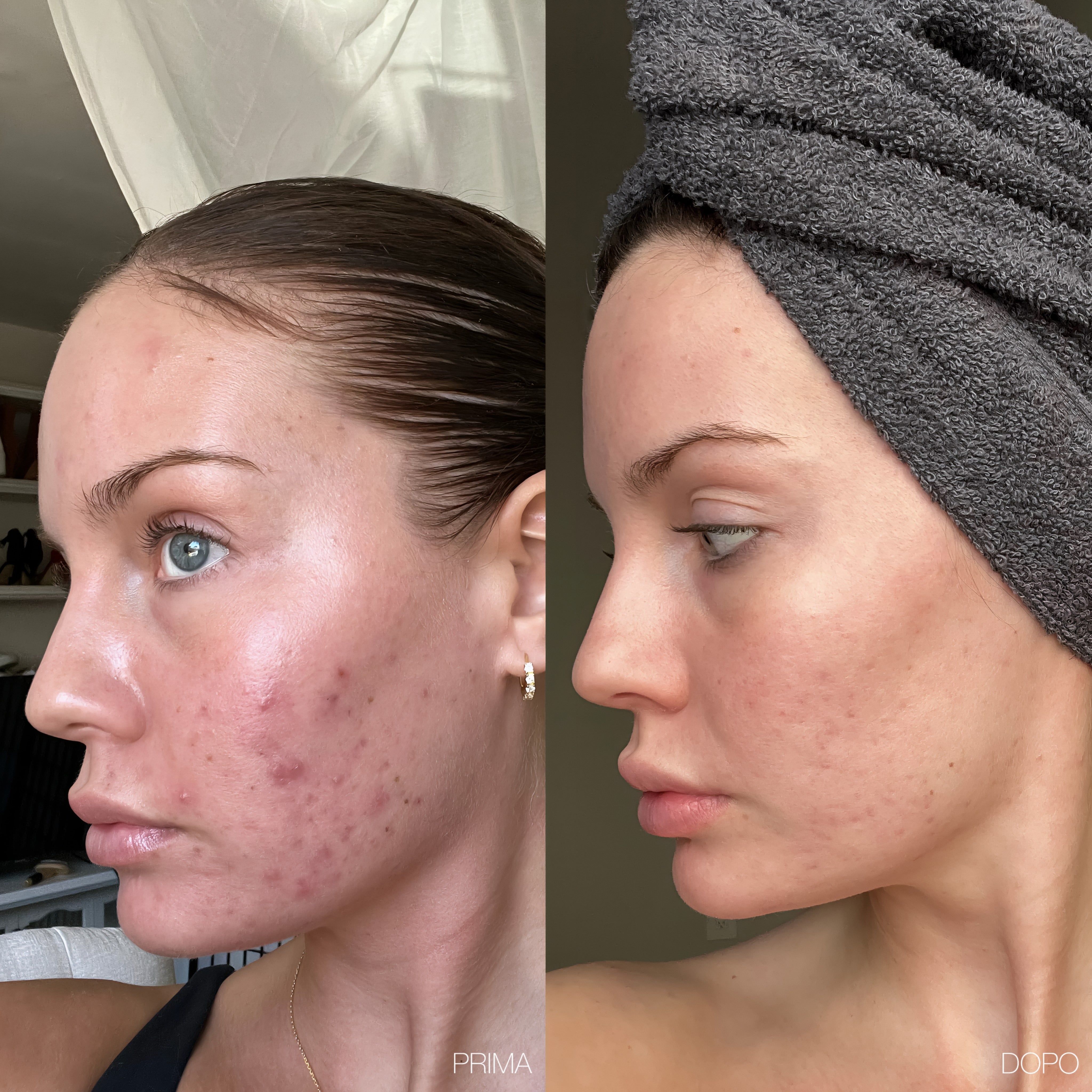 Roxy- 6 in 1 Derma Roller in Titanio