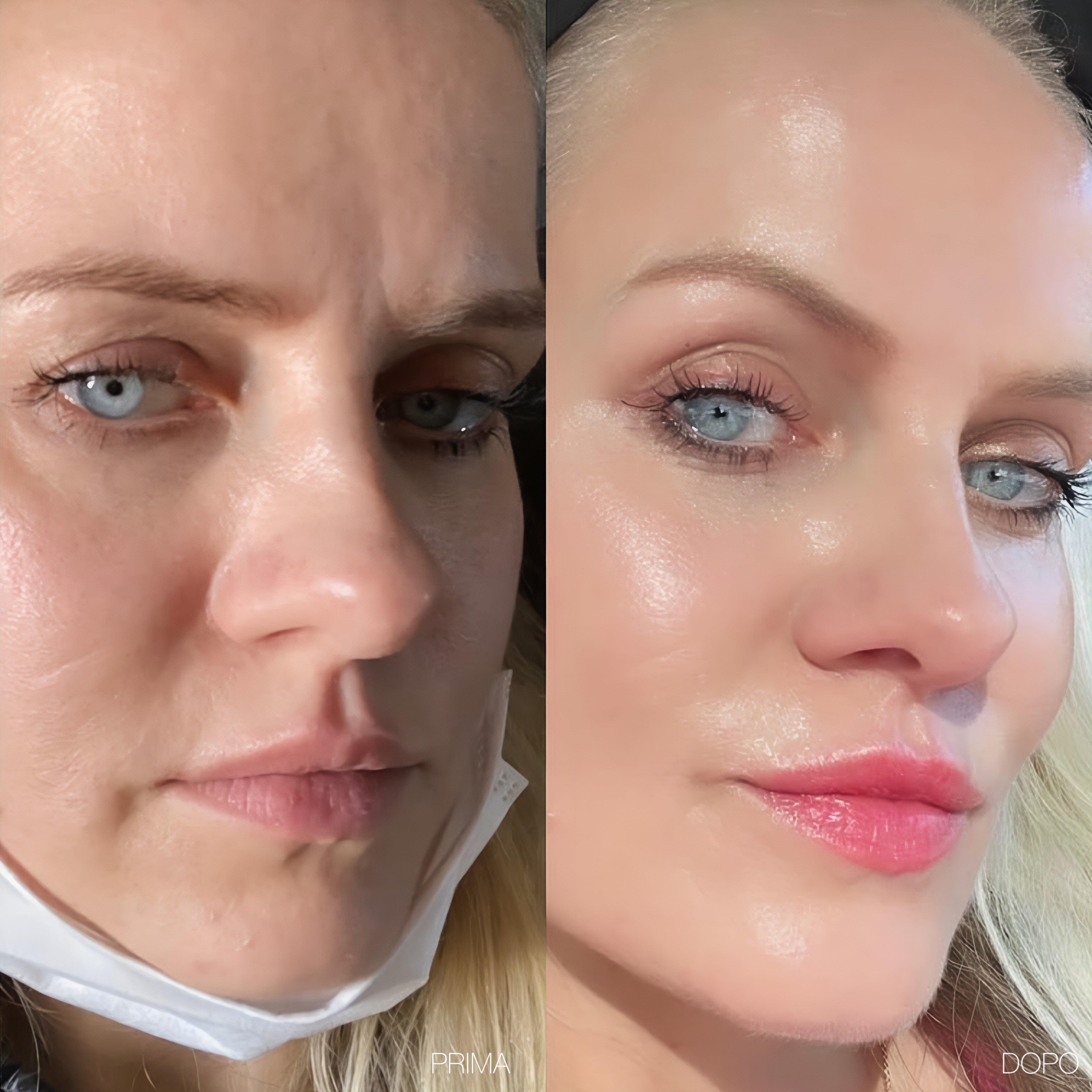 Roxy- 6 in 1 Derma Roller in Titanio