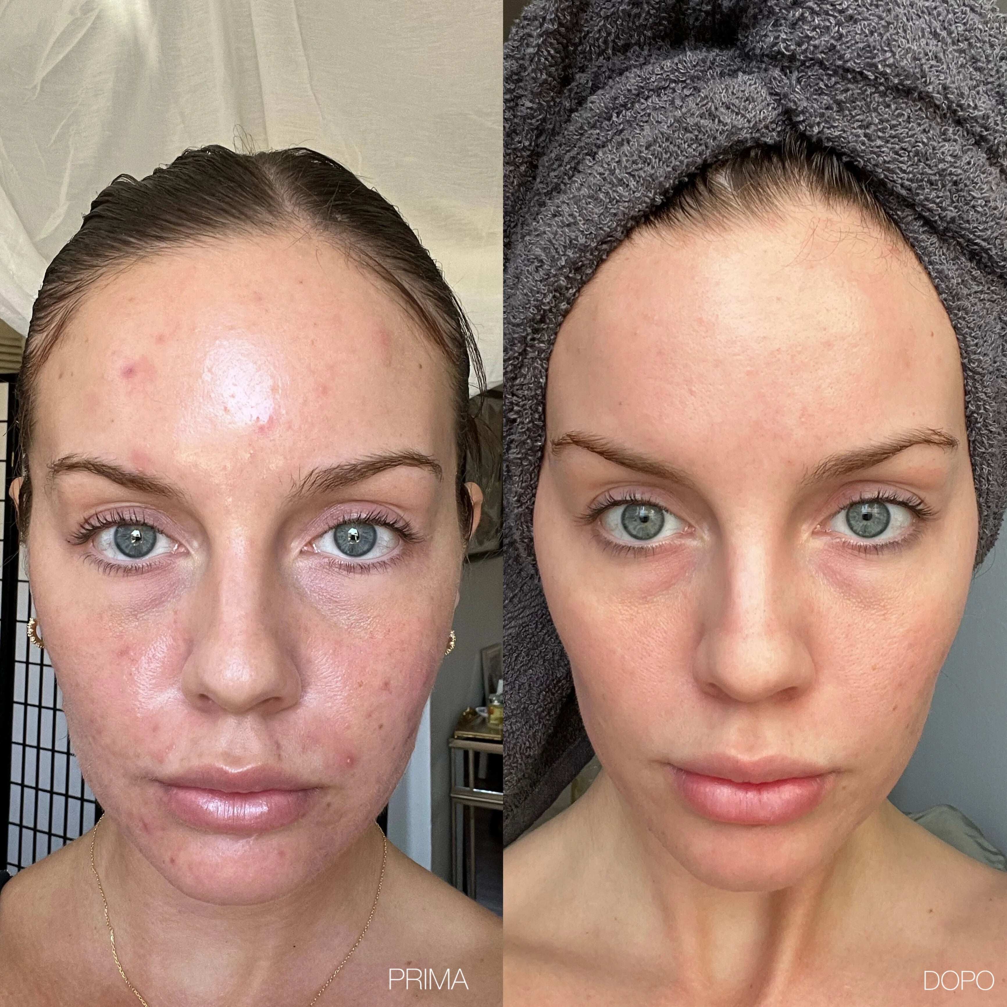 Roxy- 6 in 1 Derma Roller in Titanio